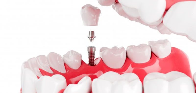 implantati